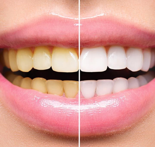 Root Canal Treatment