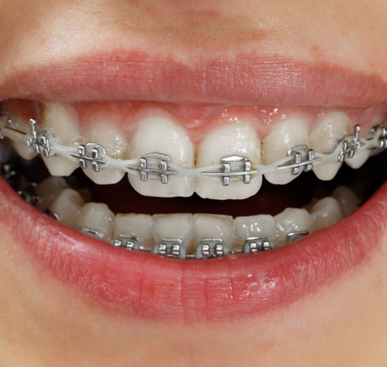 Root Canal Treatment