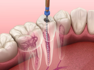 Root Canal Treatment